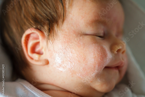Canvas Print Neurodermatitis Chronic constitutional atopic eczema small newborn baby with dry