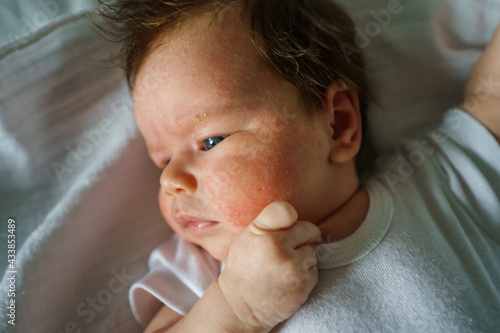 Obraz na płótnie Neurodermatitis Chronic constitutional atopic eczema small newborn baby with dry