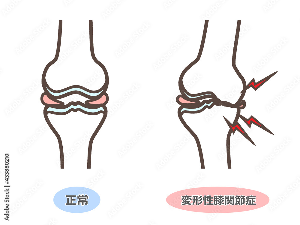 変形性膝関節症のイラスト 変形性膝関節症のイラスト