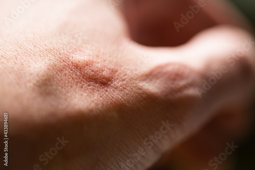 Allergic rash after contact allergy  pustules  spots  blisters and wheals on the skin as allergic reaction