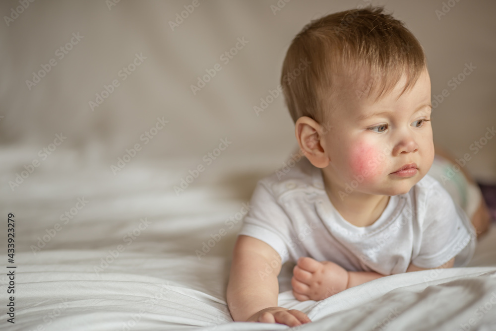 Atopic dermatitis eczema in baby.Condition that causes the skin to