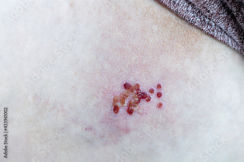Woman with Shingles or Herpes Zoster on skin, it is raised red bumps and blisters caused on body. Medicine treatment for varicella-zoster virus infection concept. photo
