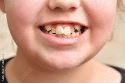 Crooked teeth in a child girl, close up
