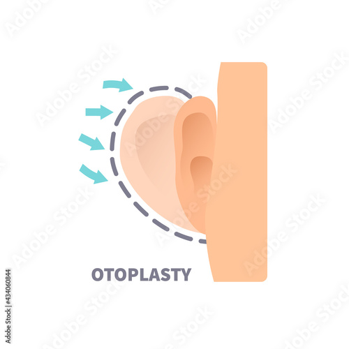 Cosmetic facial plastic ear surgery for men. Before and after otoplasty surgical correction procedure. Pinnaplasty ear pinning reshaping design template. Medical vector illustration.