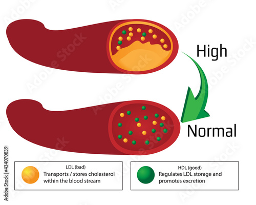 Turning high level of atherosclerotic plaque in blood vessel into normal level