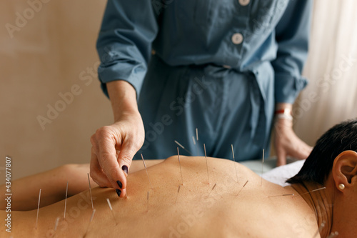 Obraz na plátně Close up image of nude woman's back with disposable acupuncture needles during traditional Chinese treatment session