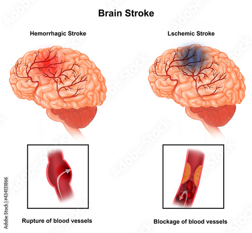 human Brain Stroke photo