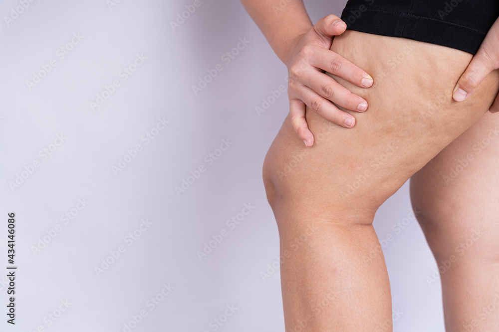 Female holding and pushing the skin of the legs cellulite or orange peel. Treatment and disposal of excess weight, the deposition of subcutaneous fat tissue