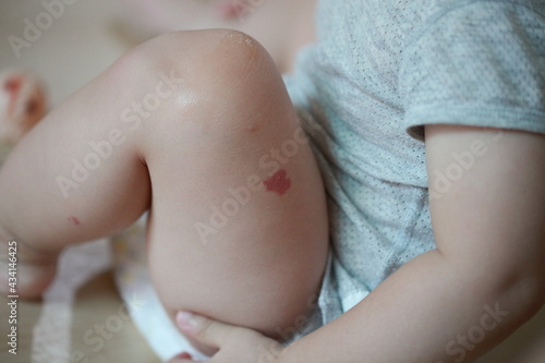 Hemangioma on baby boy's leg photo