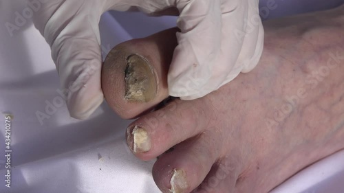 Toenails affected by fungus.