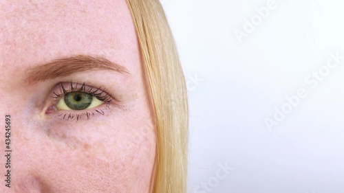 The yellow color of the woman eye. Symptom of jaundice, hepatitis or problems with the gall bladder, gastrointestinal tract, liver. Yellow eye in diseases of the liver, cirrhosis, hepatitis, bilirubin
