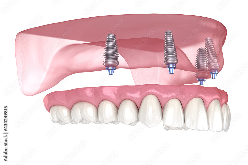 Maxillary Prosthesis Maxillary prosthesis with gum All on 4 system supported by implants ...
