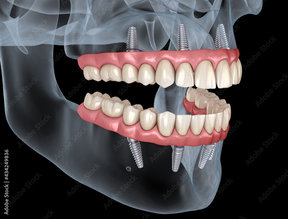 Maxillary Prosthesis Maxillary and Mandibular prosthesis with gum All on 4 system supported ...