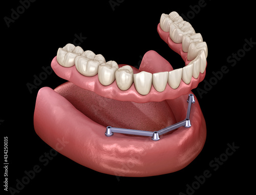 Mandibular prosthesis with gum All on 4 system supported by implants.  Medically accurate 3D illustration of human teeth and dentures concept photo