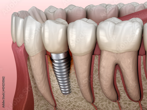 Periimplantitis with visible bone damage. Medically accurate 3D illustration of dental implants concept photo