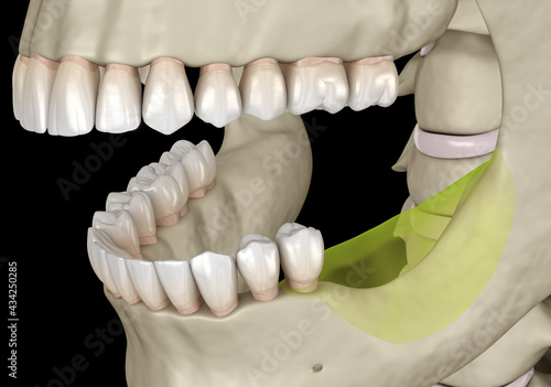 Mandibular Jaw, bone recession after losing molars teeth. Medically accurate dental 3D illustration photo