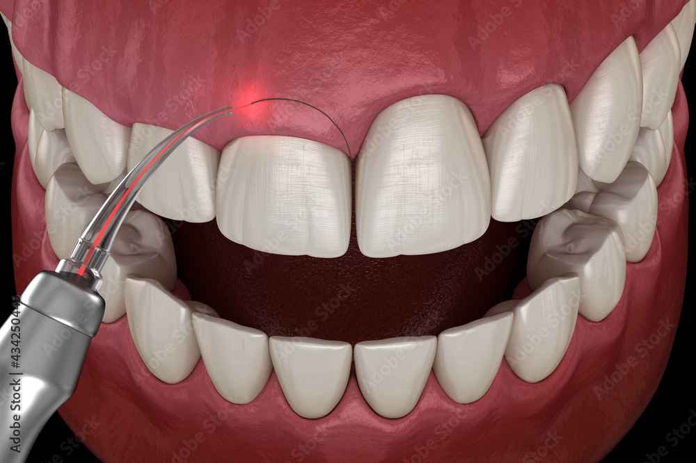 Gingivectomy surgery with laser using. Medically accurate tooth 3D