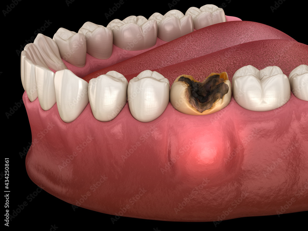 Periostitis tooth - Lump on Gum Above Tooth. Medically accurate dental 3D illustration Periostitis tooth - Lump on Gum Above Tooth. Medically accurate dental 3D illustration