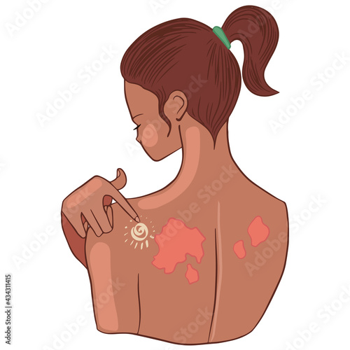 A girl smears a burn on her back with sunscreen.