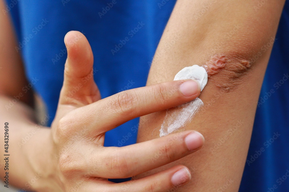 Close up at Asian woman's hand is applying medical cream at keloid scar (Hypertrophic Scar) at her elbow cause by bicycle accidental.Concepts of health care and beauty. Close up at Asian woman's hand is applying medical cream at keloid scar (Hypertrophic Scar) at her elbow cause by bicycle accidental.Concepts of health care and beauty.