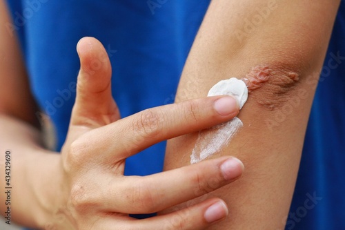Close up at Asian woman's hand is applying medical cream at keloid scar (Hypertrophic Scar) at her elbow cause by bicycle accidental.Concepts of health care and beauty.