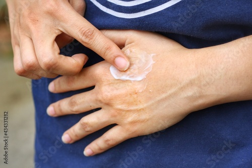 Foto Asian woman's hand is applying medical cream at burning scar on her back hand cause by electric accidental