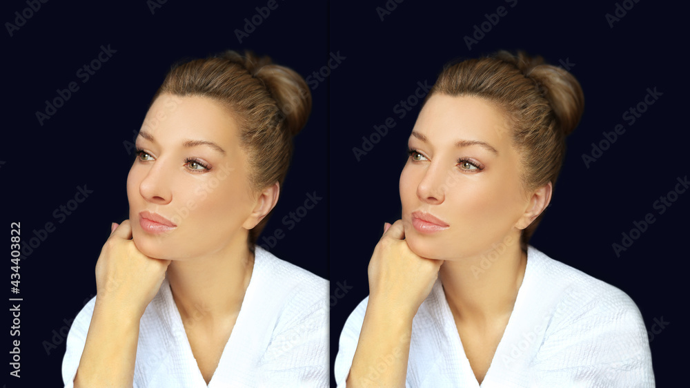 Rhinoplasty,septoplasty. Before and after correction Rhinoplasty,septoplasty. Before and after correction