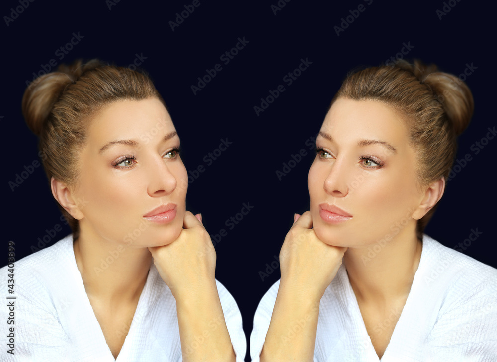 Rhinoplasty,septoplasty. Before and after correction Rhinoplasty,septoplasty. Before and after correction
