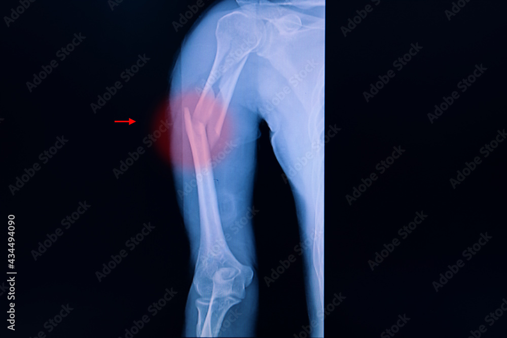 Xray film of an arm with fractured humerus. Xray film of an arm with fractured humerus.