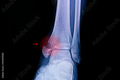 Xray film of an ankle with medial malleolus fracture. photo