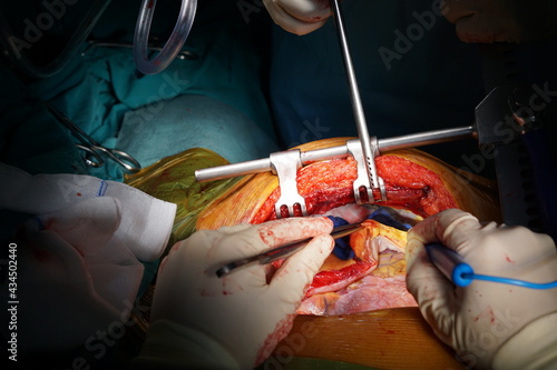 Obraz na płótnie Harvesting the left internal mammary artery (LIMA) for coronary artery bypass graft (CABG)