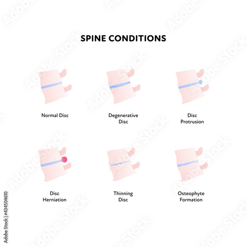 Spine disk condition. Vector flat anatomical illustration. Icon set. Protrusion, herniation, degeneration, thinning and osteophyte disease. Design for science, biology, health care.