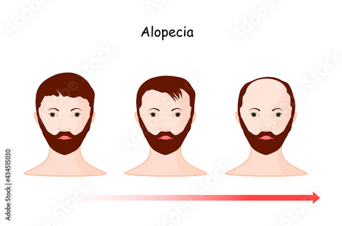 alopecia. baldness. hair loss