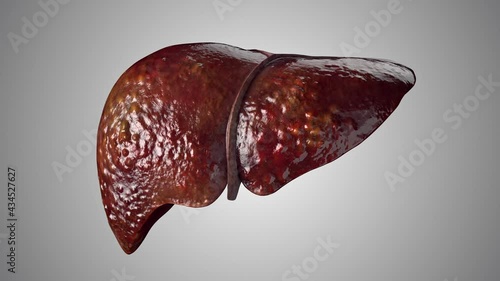 Realistic 3d animation of human liver sick stages from healthy to liver cirrhosis . High quality 4k footage photo