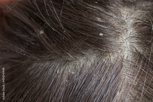 Macro photo of human hair with dandruff. Head wounds and itching, hair care, seborrheic treatment
