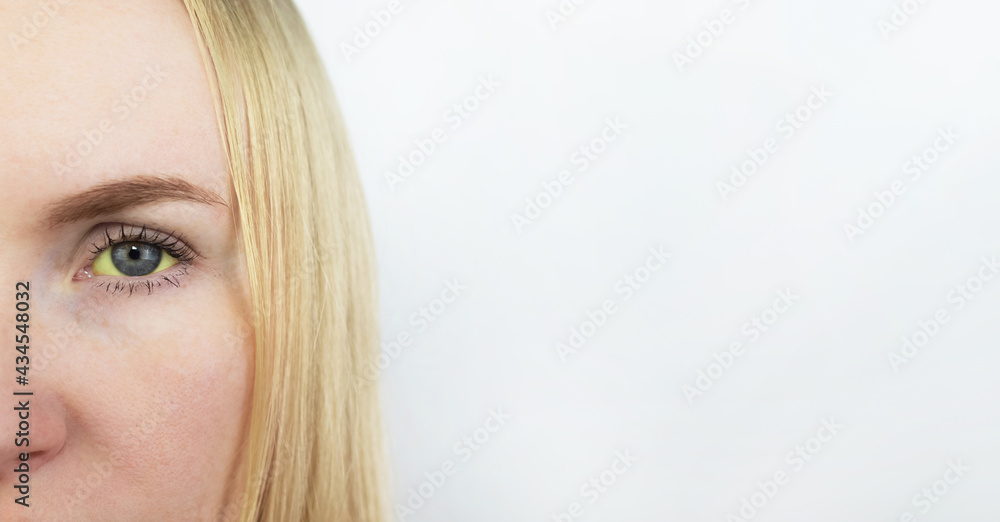 The yellow color of the woman eye. Symptom of jaundice, hepatitis or