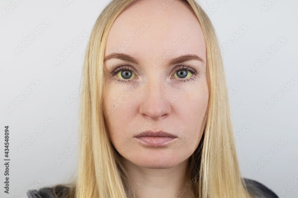 The yellow color of the woman eye. Symptom of jaundice, hepatitis or problems with the gall bladder, gastrointestinal tract, liver. Yellow eye in diseases of the liver, cirrhosis, hepatitis, bilirubin The yellow color of the woman eye. Symptom of jaundice, hepatitis or problems with the gall bladder, gastrointestinal tract, liver. Yellow eye in diseases of the liver, cirrhosis, hepatitis, bilirubin