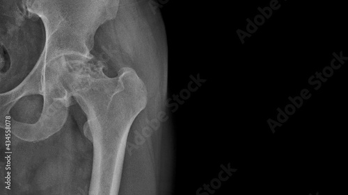 X-ray of a painful hip in a man with osteoarthritis of the left hip joint in the red area, very painful, difficult to walk, worn out joint, endoprosthetics. Surgical work required