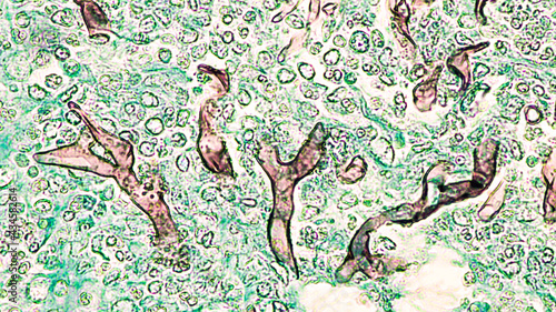 Fungal Infection - Mucormycosis: Broad, wide-angle non-septate hyphae of the fungus Mucor, from the paranasal sinus of a patient with uncontrolled diabetes mellitus.  GMS stained histology slide.   photo