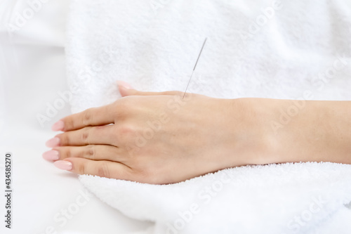 patient receiving acupuncture procedure, close-up