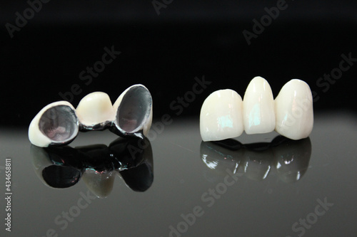 Porcelain fused to metal. PFM bridge