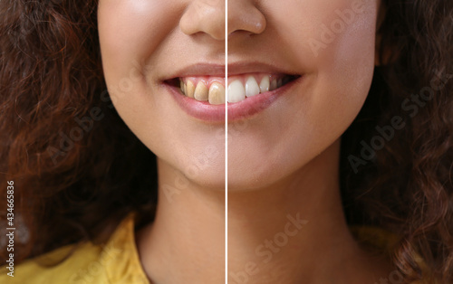 Konstfotografi Beautiful young woman before and after smile makeover procedure, closeup