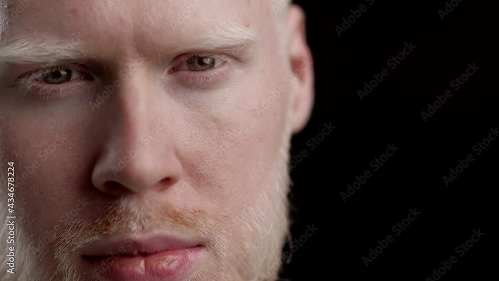 Albino Man Looking At Camera Posing On Black Background, Closeup Albino Man Looking At Camera Posing On Black Background, Closeup