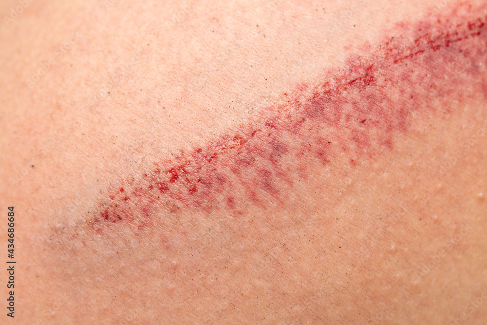 Fototapeta premium large deep scratch on the skin