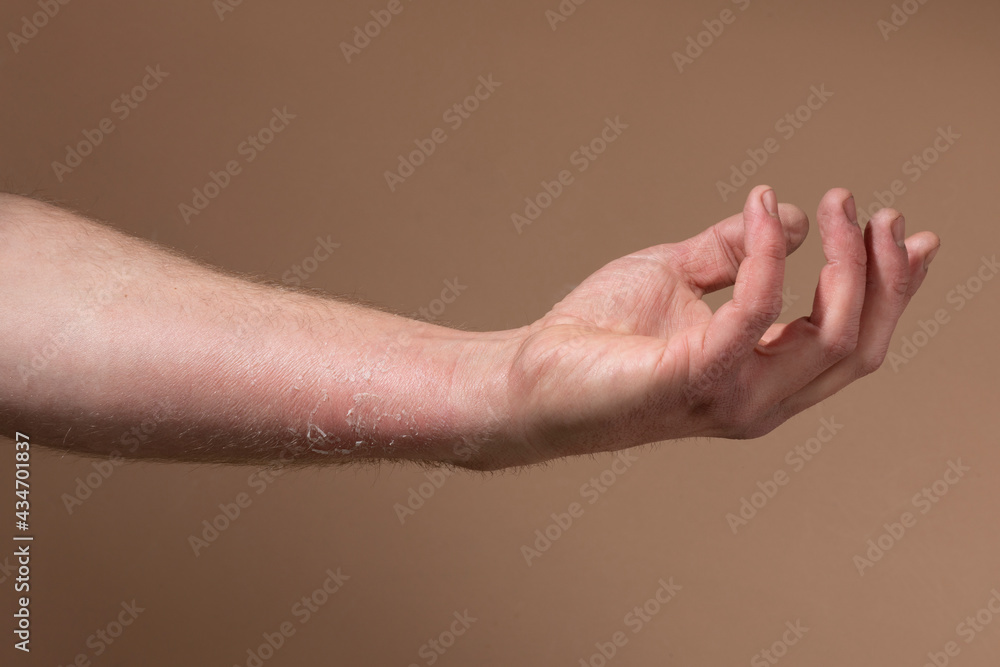 Fototapeta premium Sunburnt peeling skin on a damaged mans arm. A painful dry injured cracked part of the body healing from too much uv light without sun protection