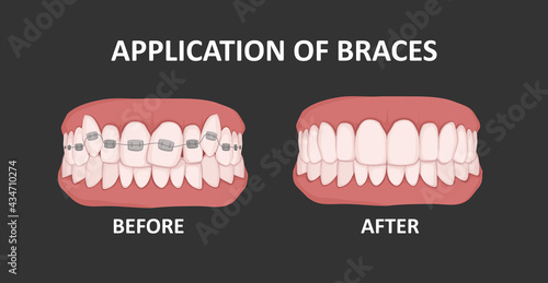 Braces on teeth, before and after. Orthodontic treatment. Crooked teeth.
