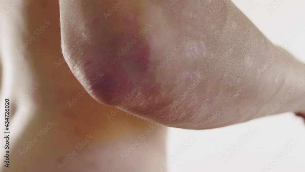 homme, psoriasis, eczéma, problème de peau, médicale, corps, femme, nu, sein, beauté, jeune, beau, peau, torse, poitrine, santé, blanc, modèle, fitness, musculaire, mince, isolé, sain, arrière, main, homme, psoriasis, eczéma, problème de peau, médicale, corps, femme, nu, sein, beauté, jeune, beau, peau, torse, poitrine, santé, blanc, modèle, fitness, musculaire, mince, isolé, sain, arrière, main,