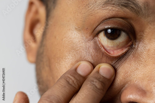 Foto yellow eye - symptom for health problem