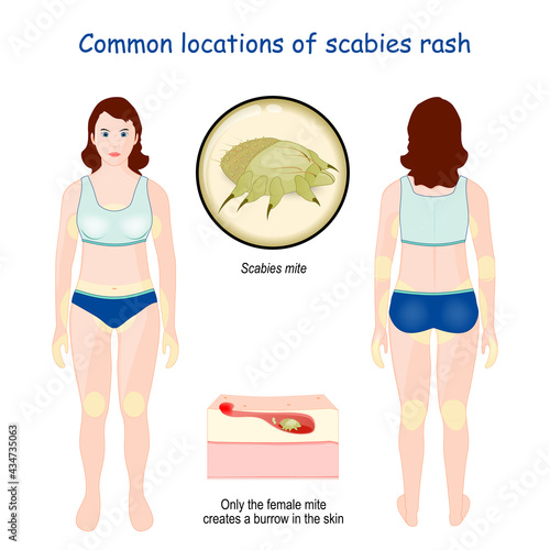Common locations of scabies rash.