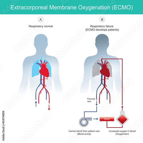 Extracorporeal membrane oxygenation. diagram for explain rescue patients respiratory failure by using instrumental  extracorporeal membrane oxygenation ECMO..